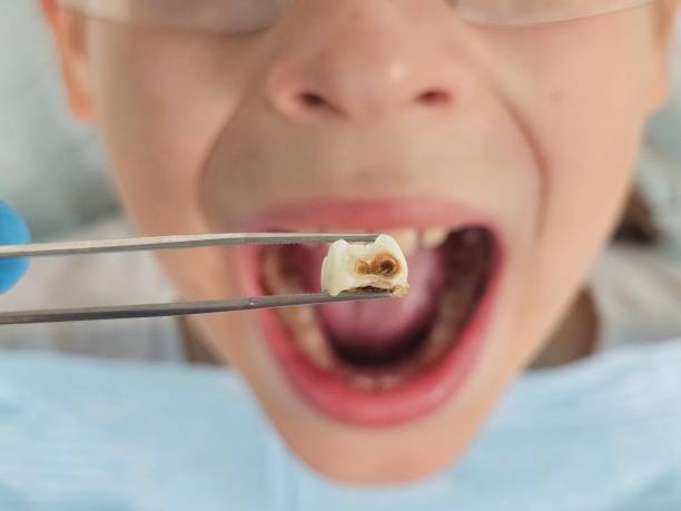 Best Emergency Wisdom Teeth Removal in Randleman, NC